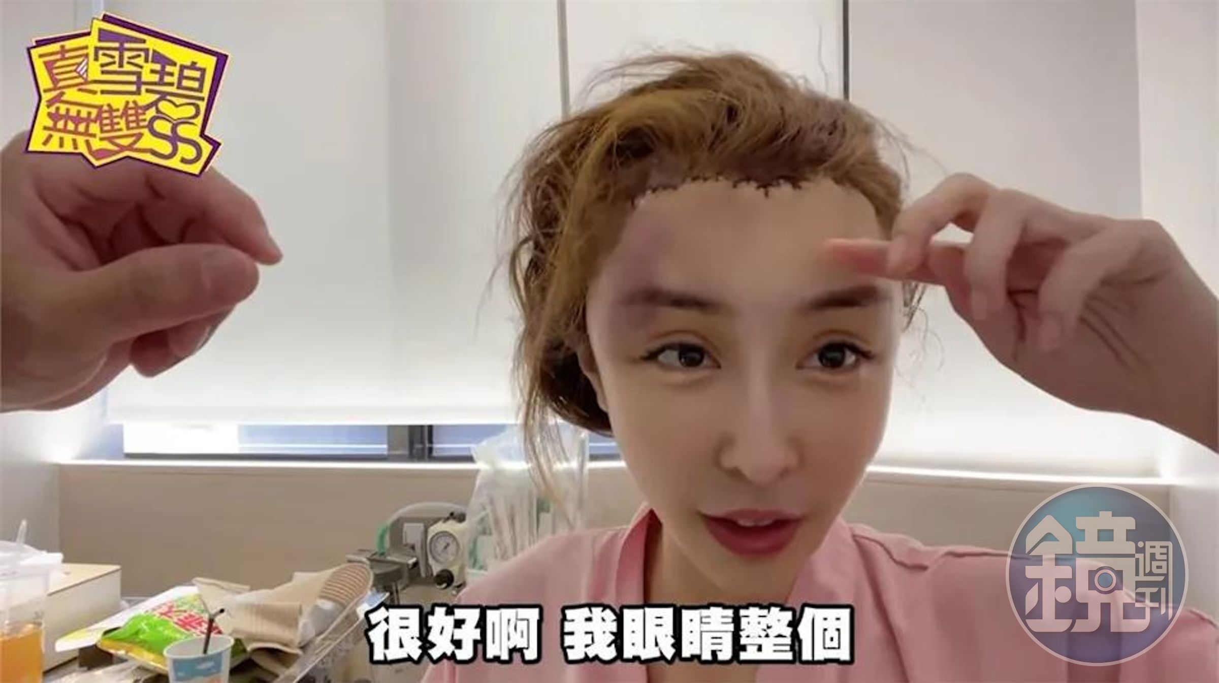 雪碧在「驚悚掀頭皮整形額頭實境」片分享自己手術前後過程。（翻攝「赤裸裸的教主雪碧」YouTube）