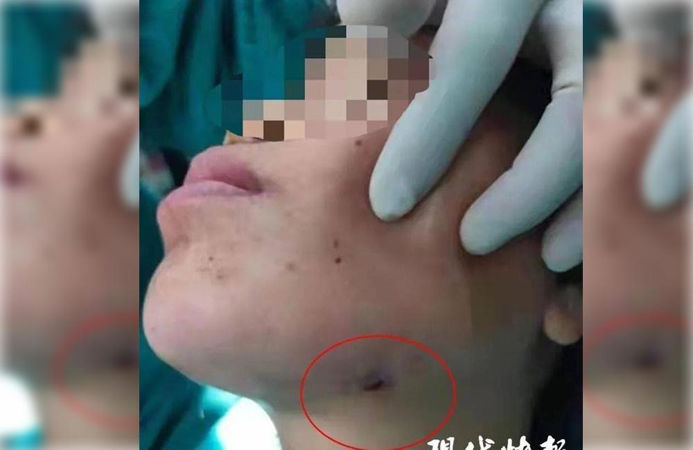中國一名女子智齒反覆發炎,不看醫生狂吃消炎藥緩解,最後臉頰穿出一個洞。(翻攝《現代快報》)