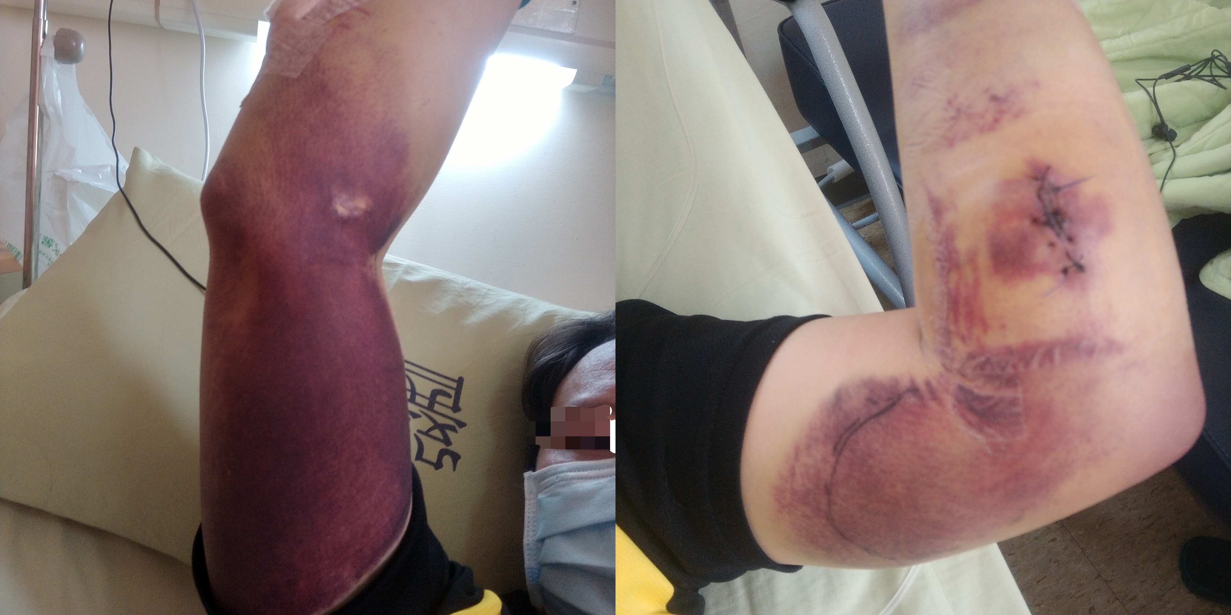 高雄1名林姓男子施打BNT／輝瑞第一劑，2天後身體開始出現血疹，接種5天後更出現血便、牙齦出血等症狀。（翻攝自爆料公社公開版）