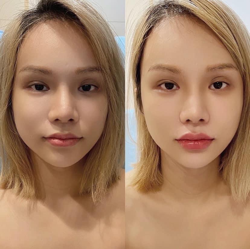 小A辣曝光整形的照片，模樣嚇人。（翻攝自小a辣臉書）