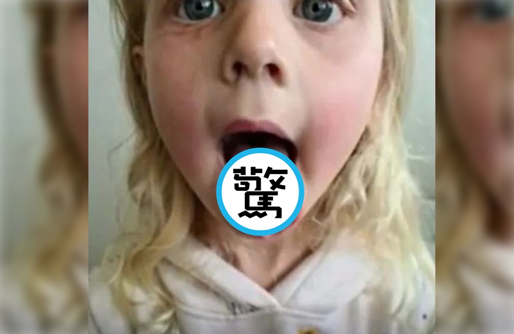 澳洲有名4歲女童一口氣吞了10顆酸糖，舌頭竟被燒出個大洞。（翻攝推特）