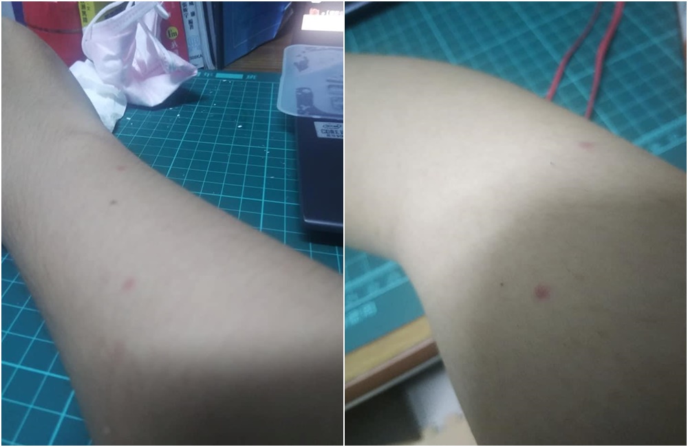 原PO和泰國妹連結後，手上出現多顆不明紅斑。（翻攝臉書「爆廢公社」）