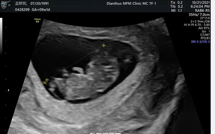 孟耿如PO出超音波照，公開自己懷孕3個月。（翻攝自孟耿如臉書）