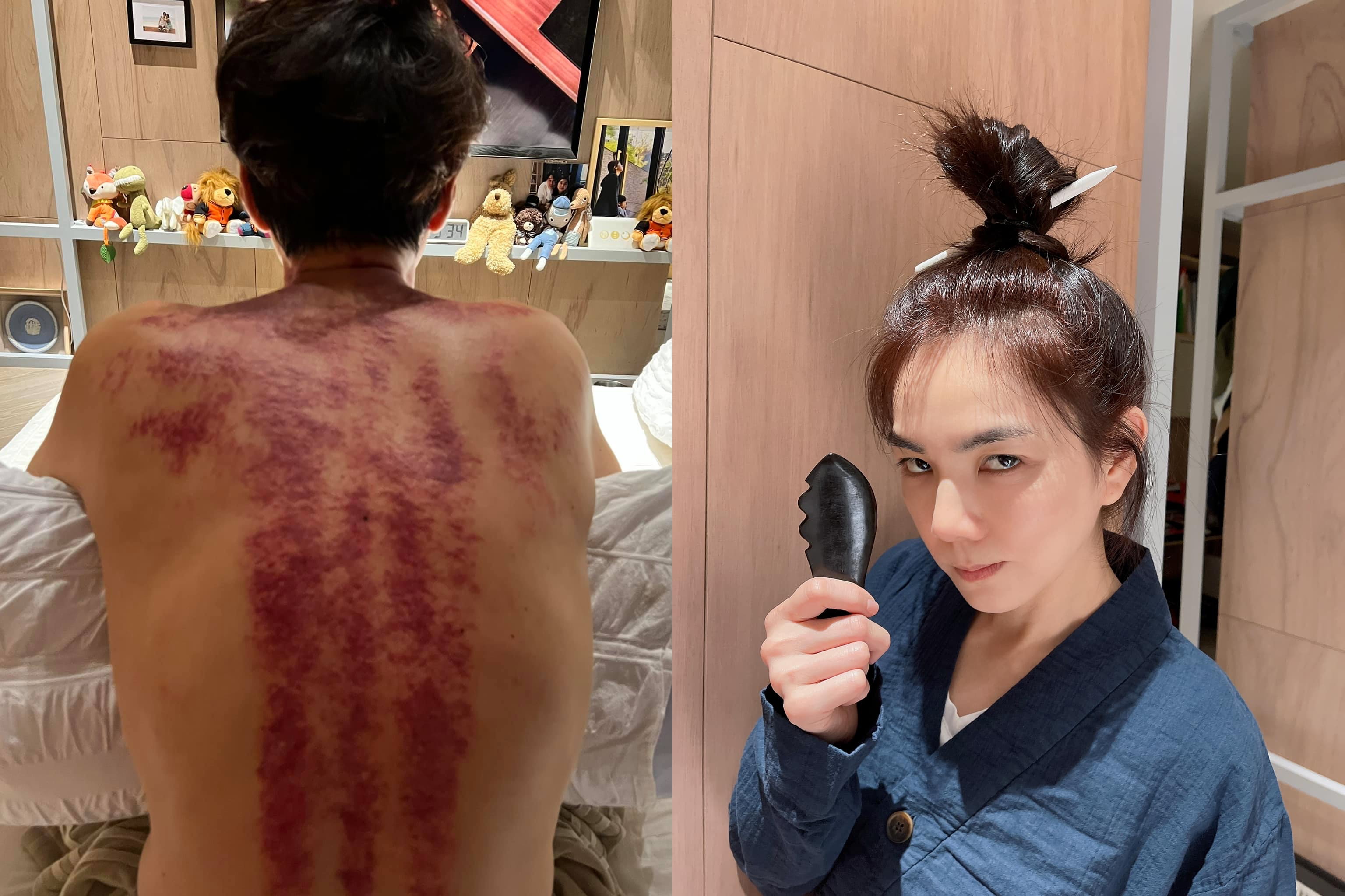 解孵超堵塞欠刮，Ella功力高強，竟刮出這樣一大片痧。（Ella臉書）