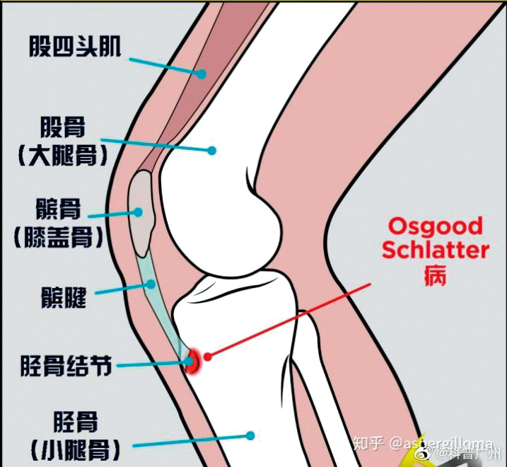 「奧斯古—謝拉德症」是跑跳運動時，脛骨結節被髕骨肌腱拉扯導致發炎。（翻攝自科普廣州微博）