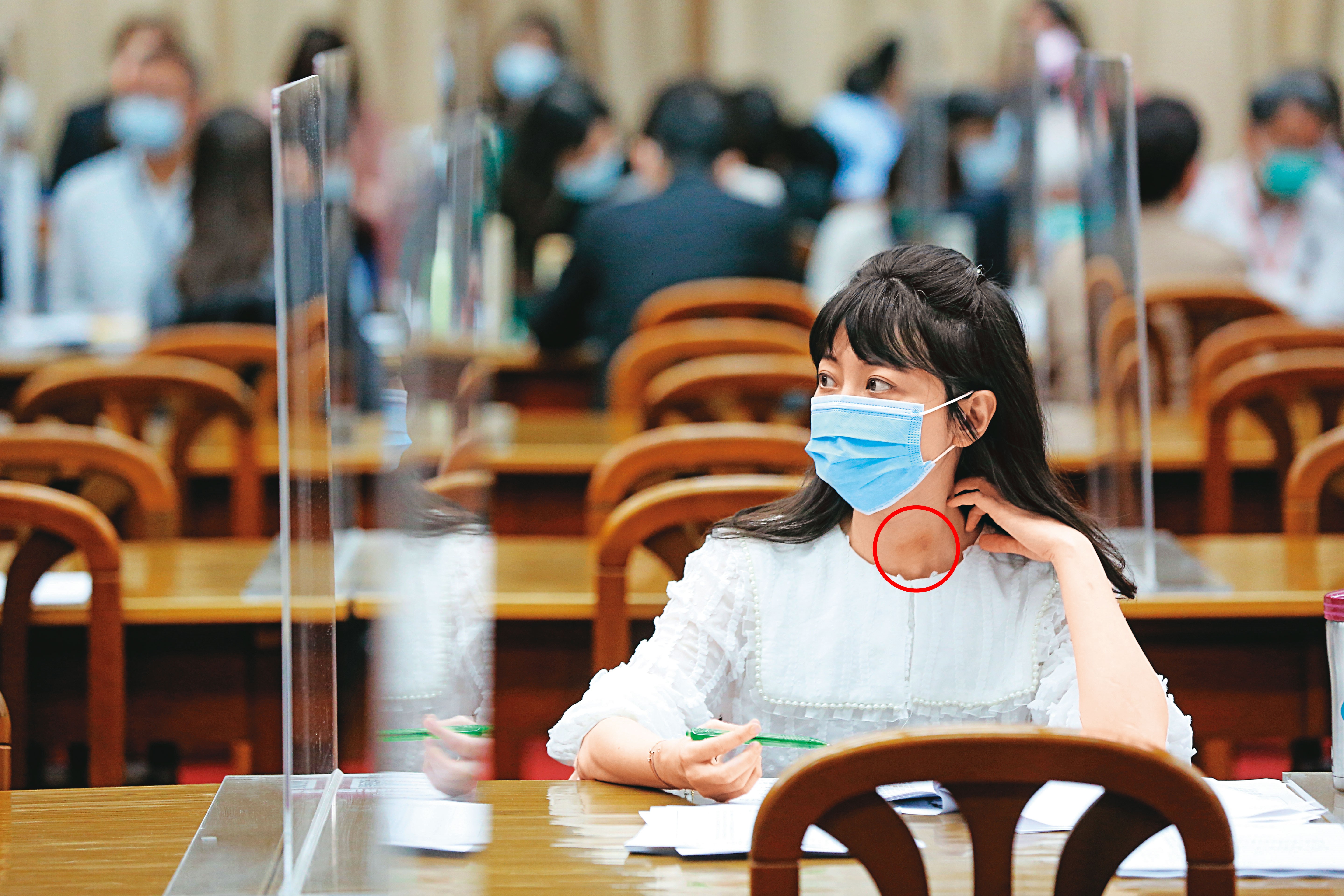 高嘉瑜29日現身立法院財委會等候質詢時，脖子上的瘀傷（紅圈處）還清晰可見。