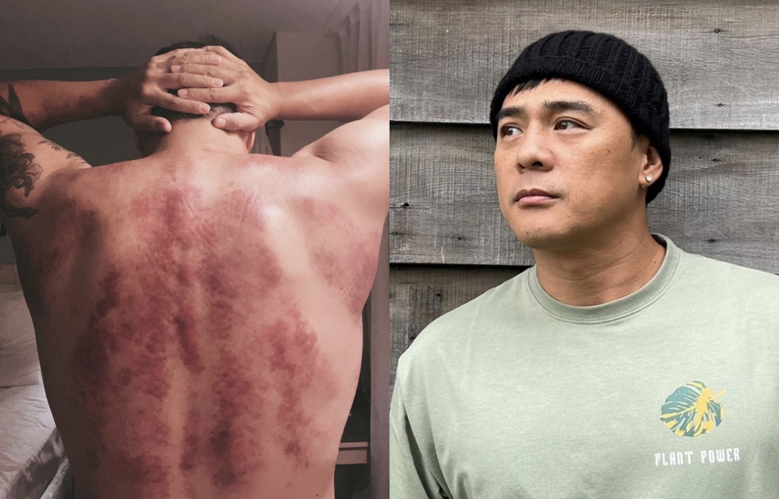 竇智孔太疲累去刮痧結果滿是血痕，且近期水腫嚴重，外景錄影隔天就會犯胃炎。（竇智孔提供）