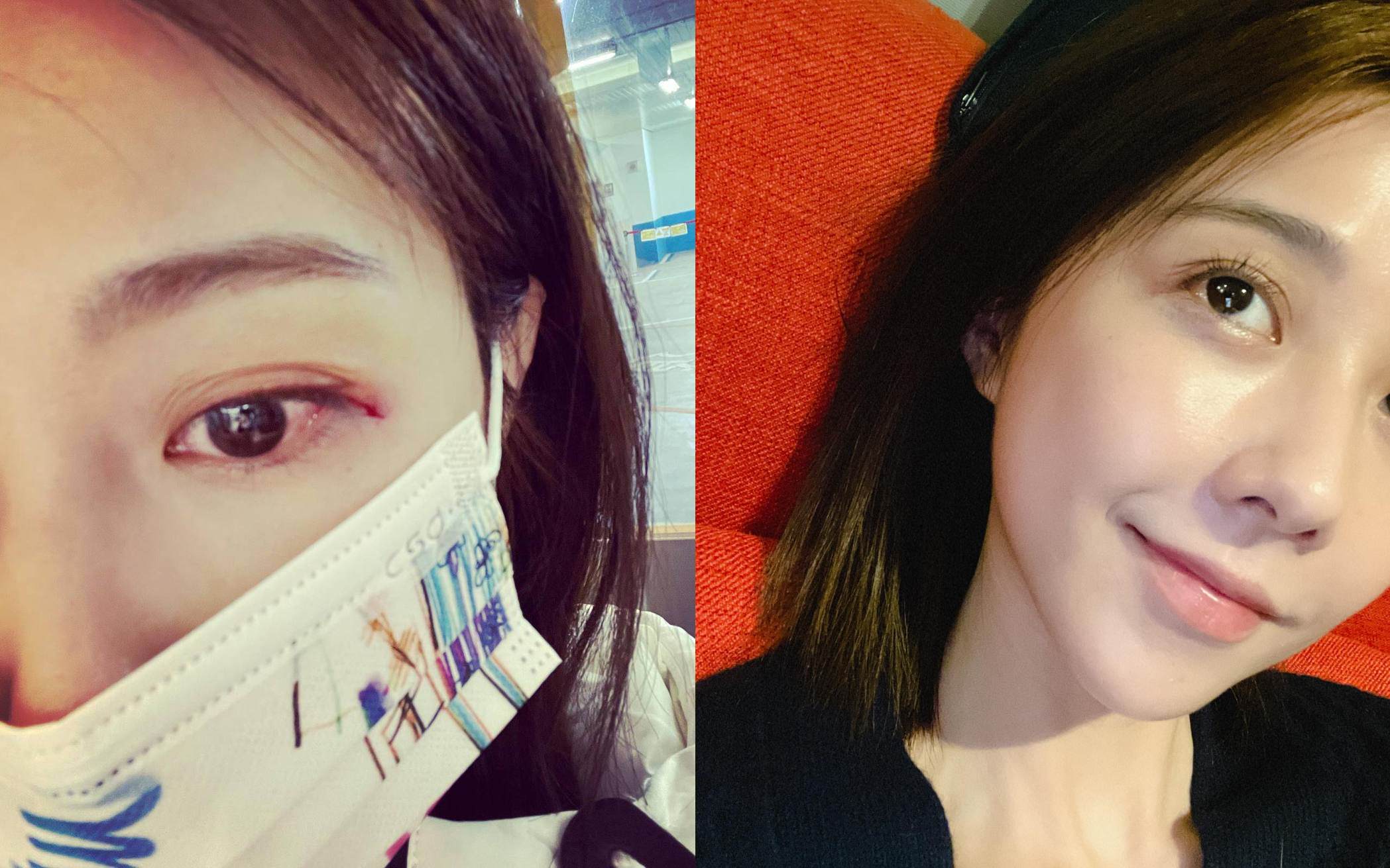 邵雨薇4天前受傷，2張照片對照，看得出恢復狀況頗佳。（翻攝自邵雨薇臉書）