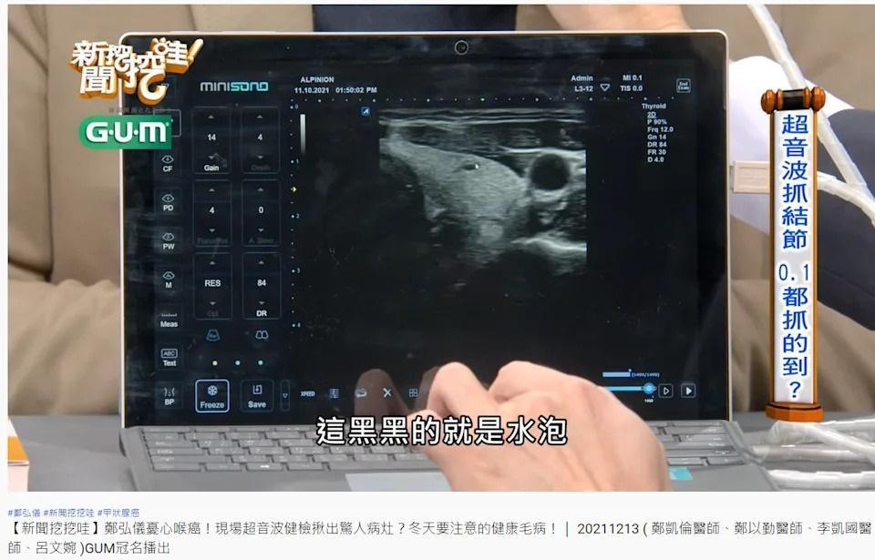 超音波機器顯示鄭弘儀甲狀腺有一顆水泡。(翻攝自新聞挖挖哇YouTube)