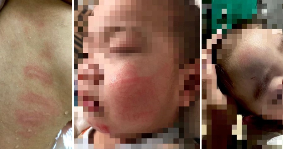 男童全身是傷，保母卻辯是「玩耍撞到」。（網友授權提供）