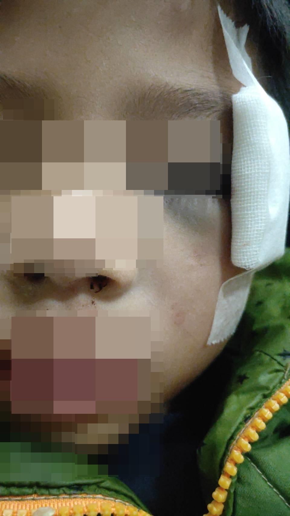 王童被同學撞擊後，造成嚴重性顴骨閉鎖性骨折、眼瞼周圍區域擦傷，住院治療5天。（劉美芳服務處提供）