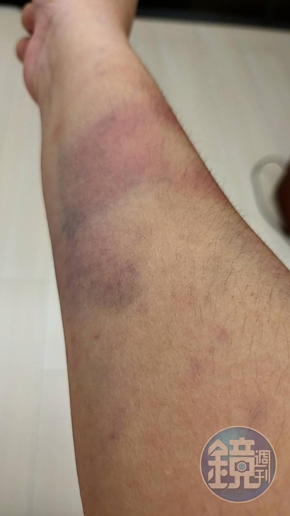 C女遭毆打,導致四肢多處大片挫傷瘀青。(讀者提供)