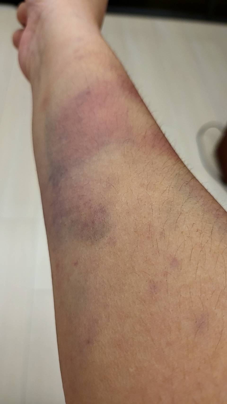 C女遭毆打，導致四肢多處大片挫傷瘀青。（讀者提供）