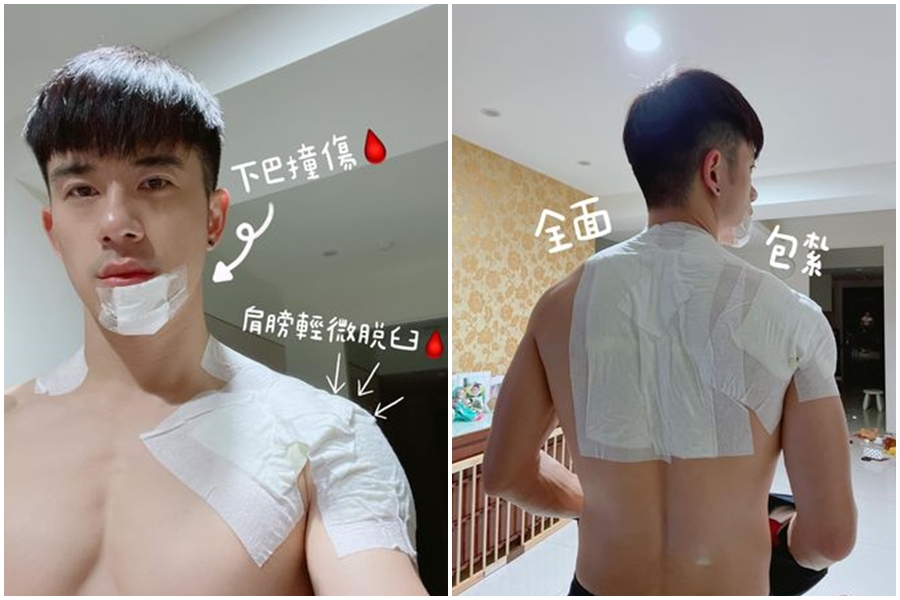 紀言愷秀出傷勢，全身都是傷，他也提醒自己下次千萬要注意。（翻攝自紀言愷臉書）