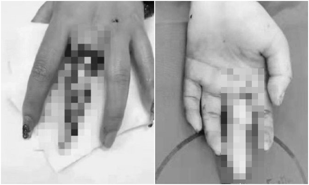 中國一名19歲女子的手指連皮帶肉被扯下，只剩一節白骨。（左翻攝微博，右翻攝網易）