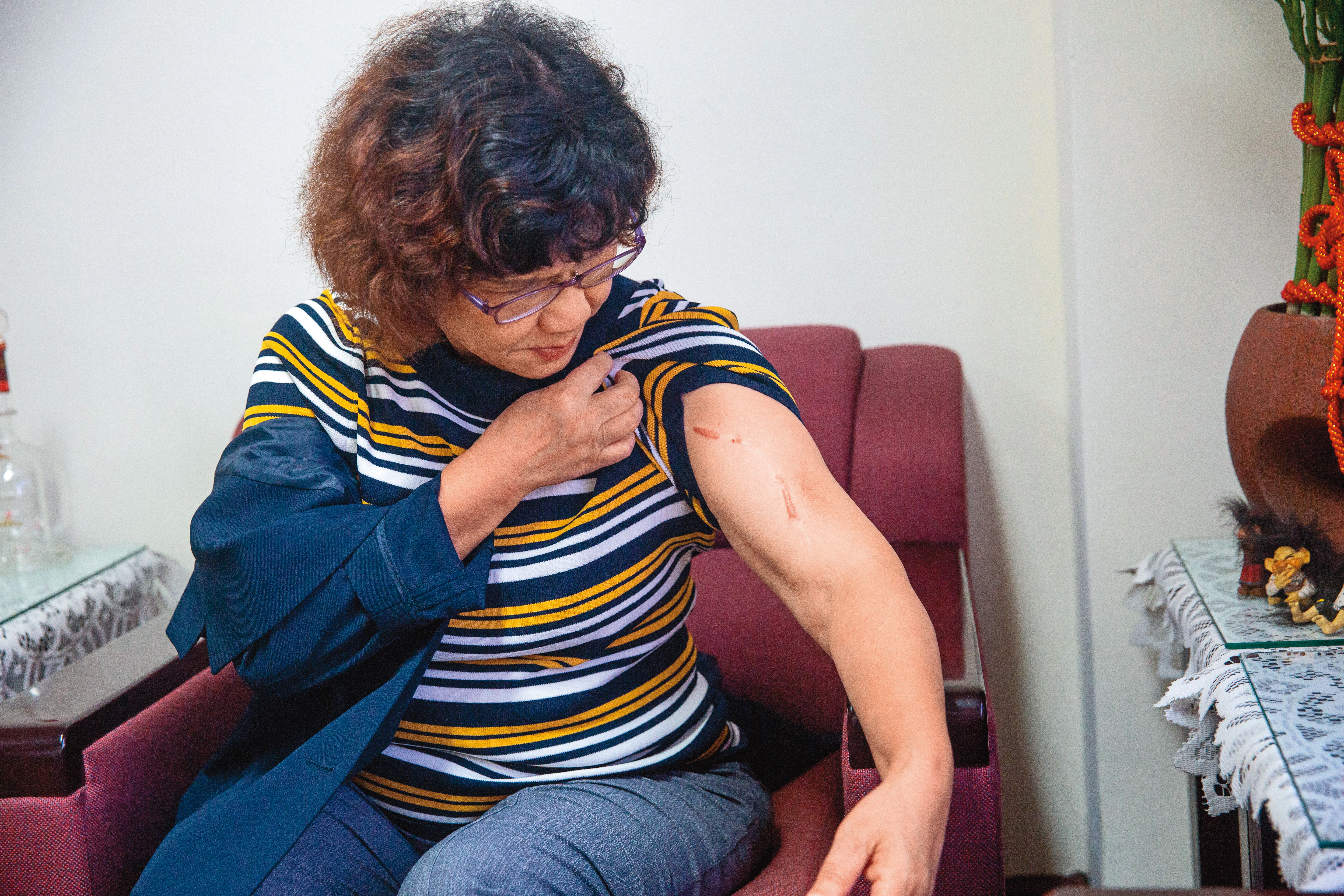 6年前，兒子第一次出現嚴重的情緒行為，王幼玲2次被推倒骨折。（林煒凱攝）