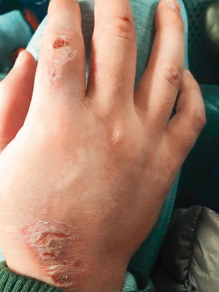 王幼玲的兒子一焦慮就搓手，最近他把自己的手搓得皮開肉綻，仍無法停止。（王幼玲提供）