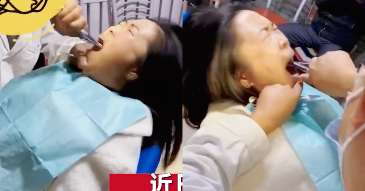 中國一名大姐在拔智齒時，被牙醫狂拉猛扯1小時才拔除。（翻攝自星視頻）