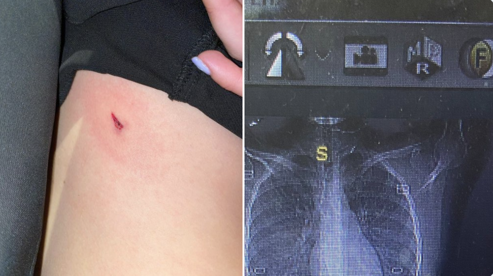 約旦一名女子3個月前參加一場婚禮，沒想到卻意外發現自己中彈。（翻攝自Twitter @glick_sh）