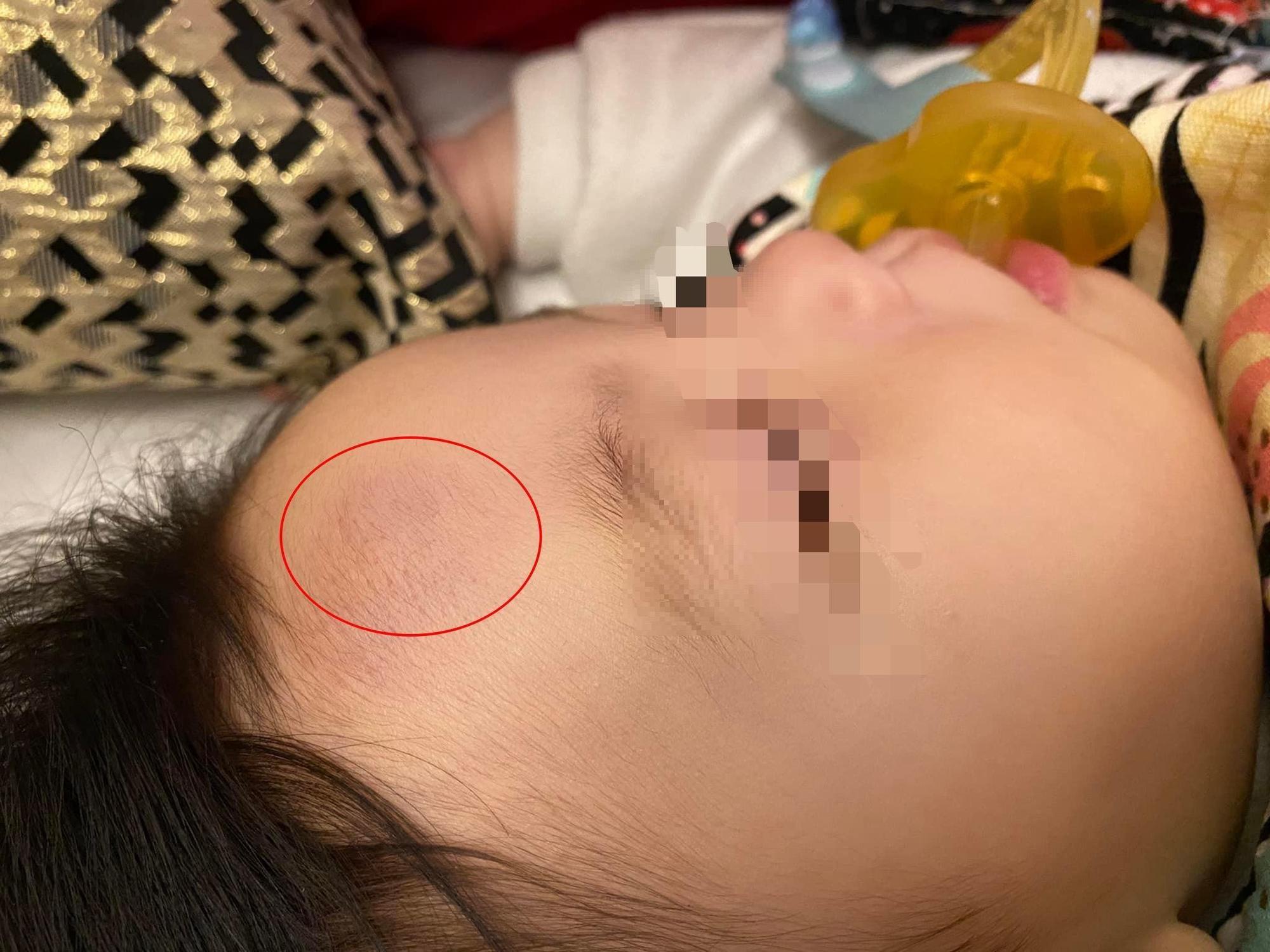 女兒因從嬰兒床摔落到地板,額頭腫了一塊瘀青。(翻攝自爆料公社公開版)