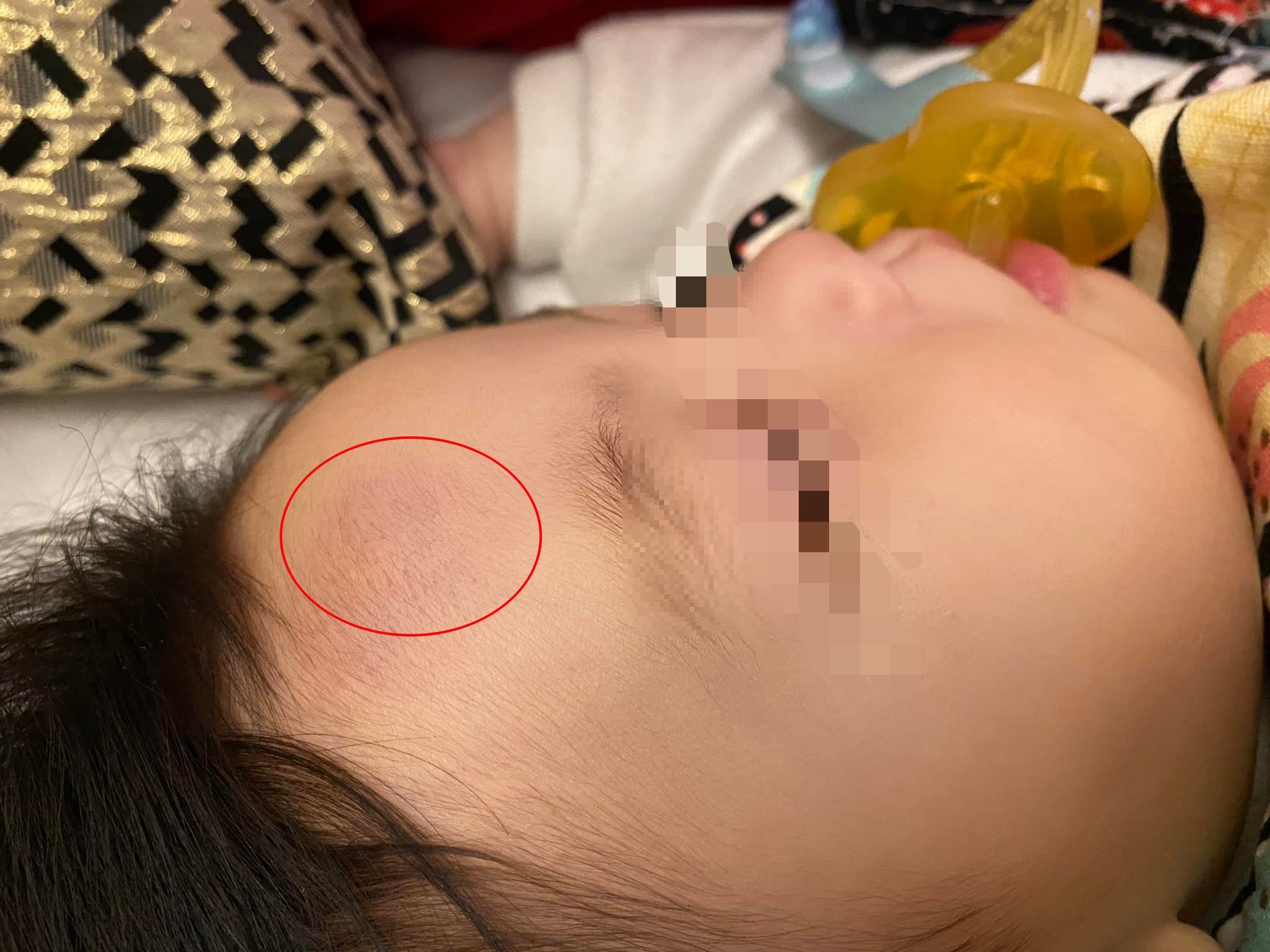 女兒因從嬰兒床摔落到地板,額頭腫了一塊瘀青。(翻攝自爆料公社公開版)