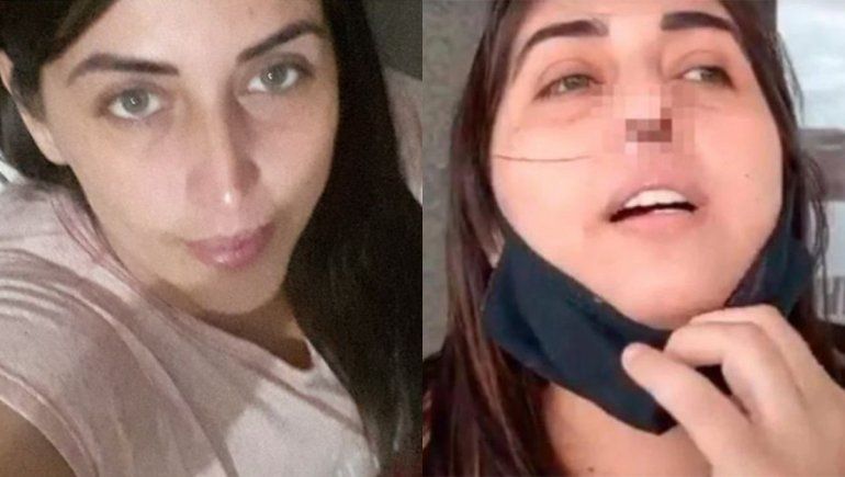 阿根廷一名長照工作者因PCR篩檢遭鼻子細菌感染,最後只剩一個鼻孔。(翻攝自推特)