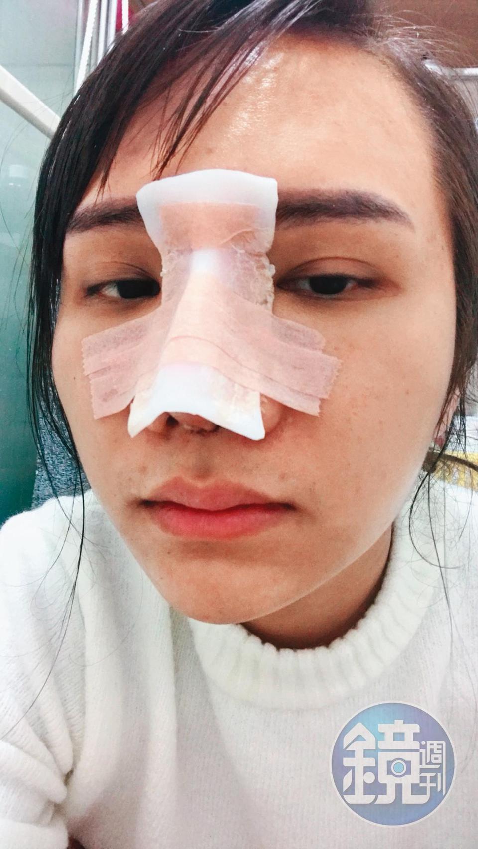 小A辣鼻子動了不少次,她覺得整形自己爽就好,不要在意他人的眼光。(小A辣提供)