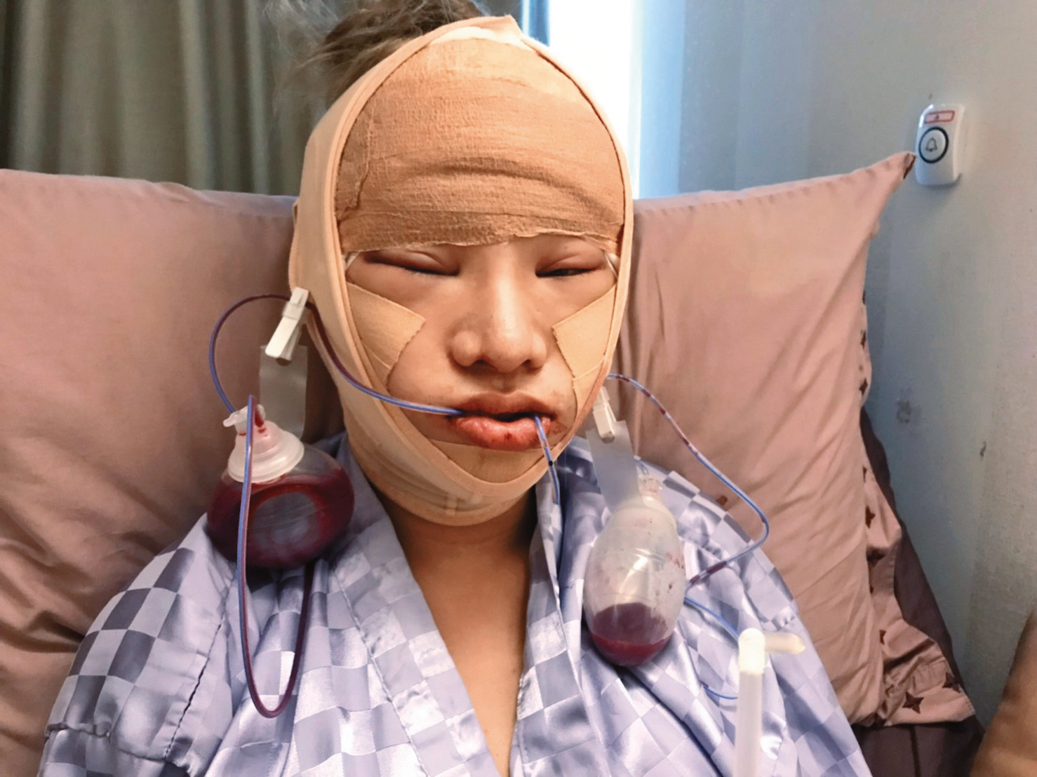 根據本刊估計，小A辣花在全身上下整形的費用已超過300萬元。（小A辣提供）