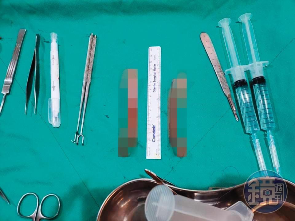 術後小A辣想把自己的骨頭做成項鍊紀念,可惜目前找不到商家替她圓夢。(小A辣提供)