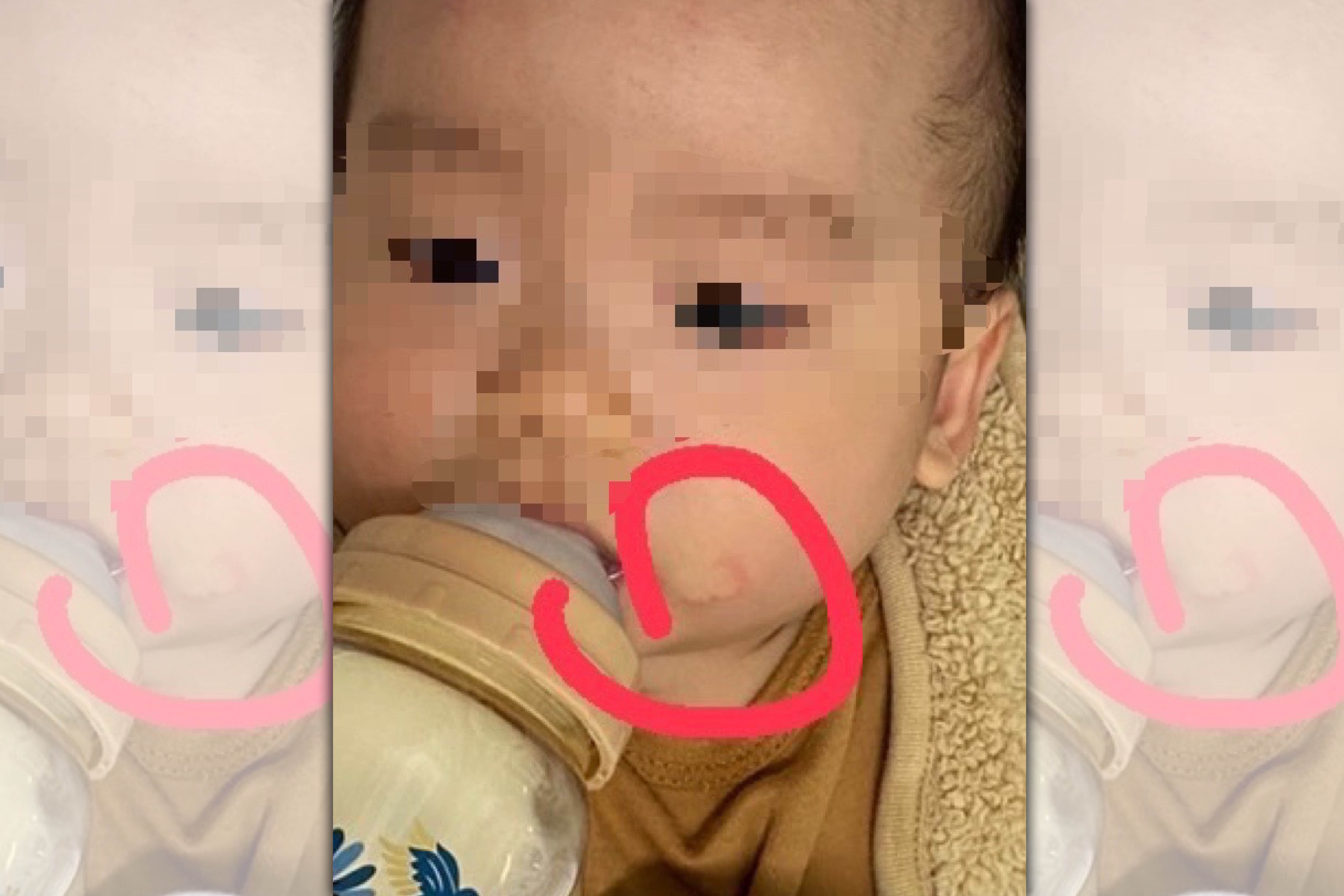 A小姐的兒子臉頰紅腫,疑似遭保母施虐。(讀者提供)