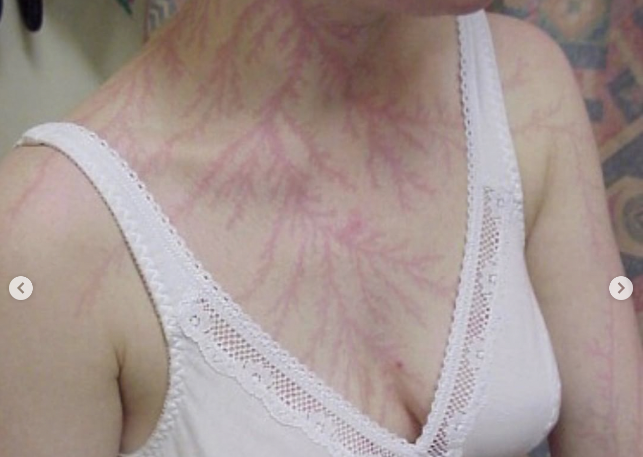 英國一名女子被雷擊中後奇蹟生還，身上還多了如蕨類般的紅色圖騰。（翻攝自闕壯理IG）