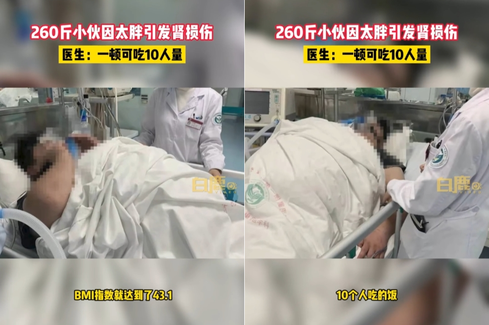 中國有一名男子一天只吃一餐，一餐卻高達10人份，引發肥胖相關疾病。（翻攝自微博）
