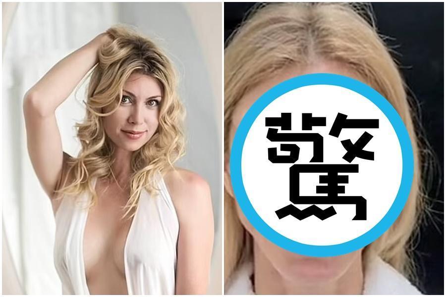俄羅斯選美皇后塔拉瑟薇琪因手術失敗，再也找不回過去漂亮的臉蛋。（翻攝自推特）