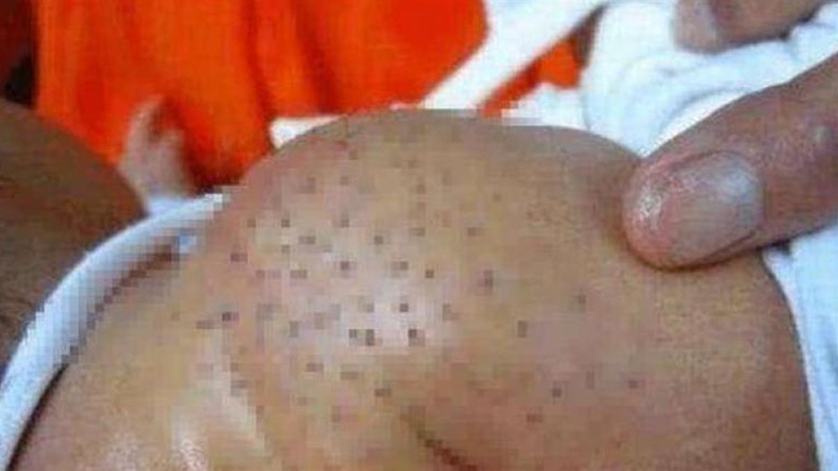 婆婆誤信偏方，害寶寶身上長出大量黑色斑點，看上去就像豬皮。（翻攝微博）