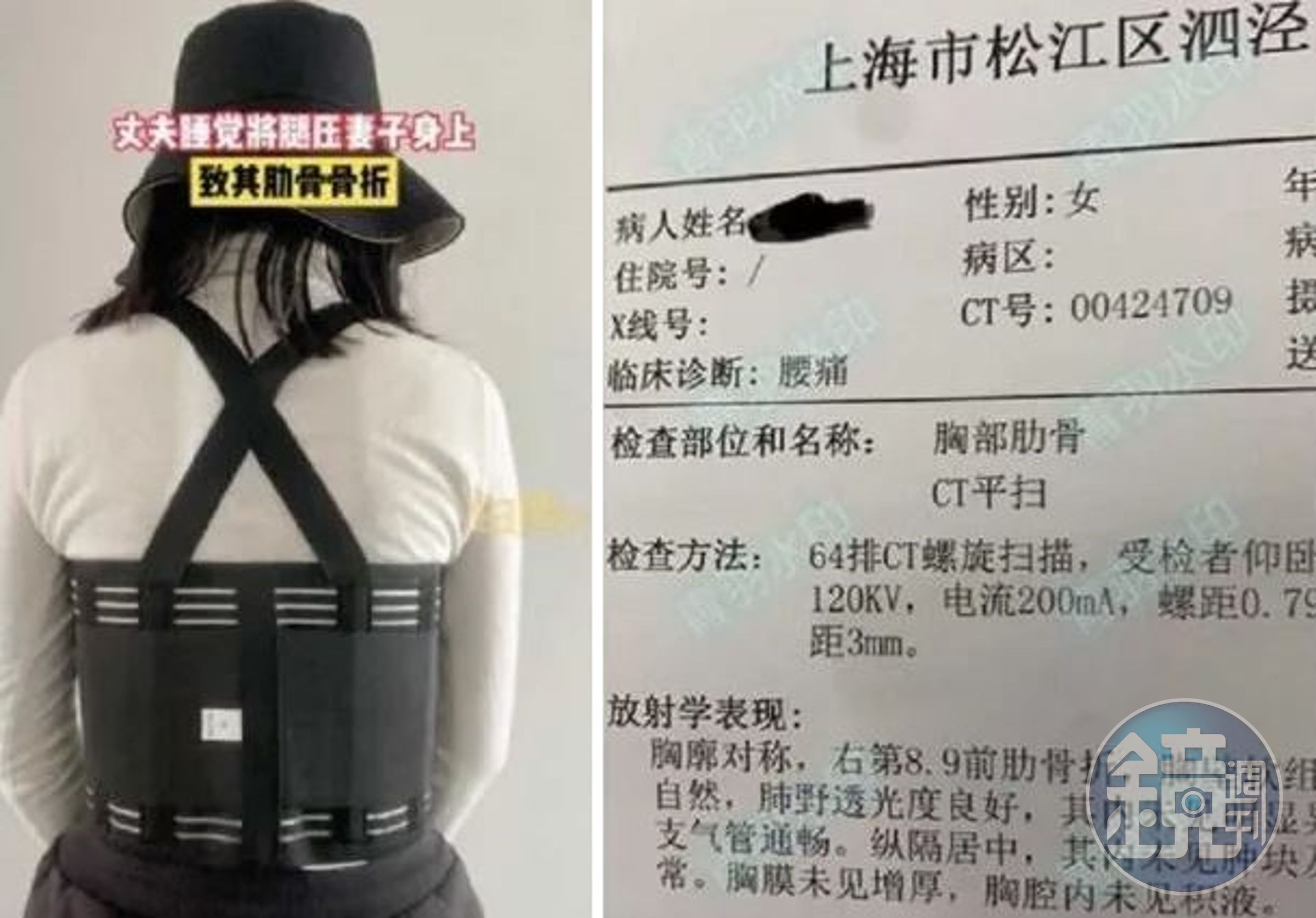 人妻懷疑自己因為骨質疏鬆才容易骨折。（翻攝微博）