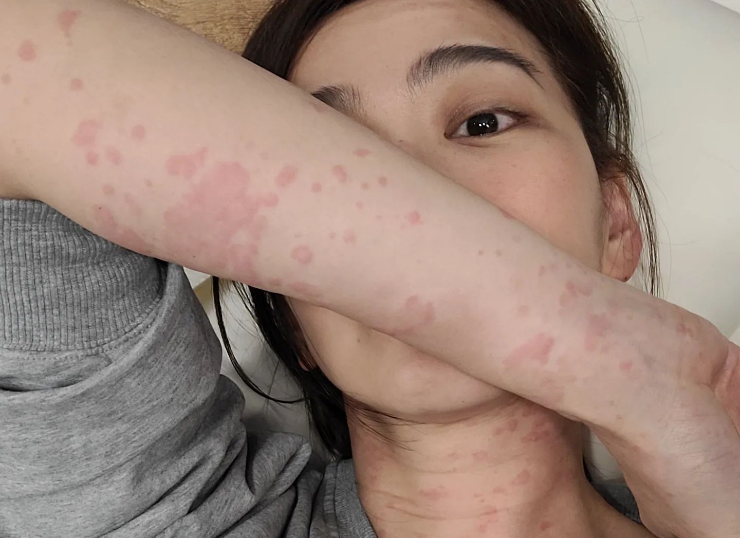 邵庭po出全身過敏照，模樣頗為嚇人。（翻攝自邵庭臉書）