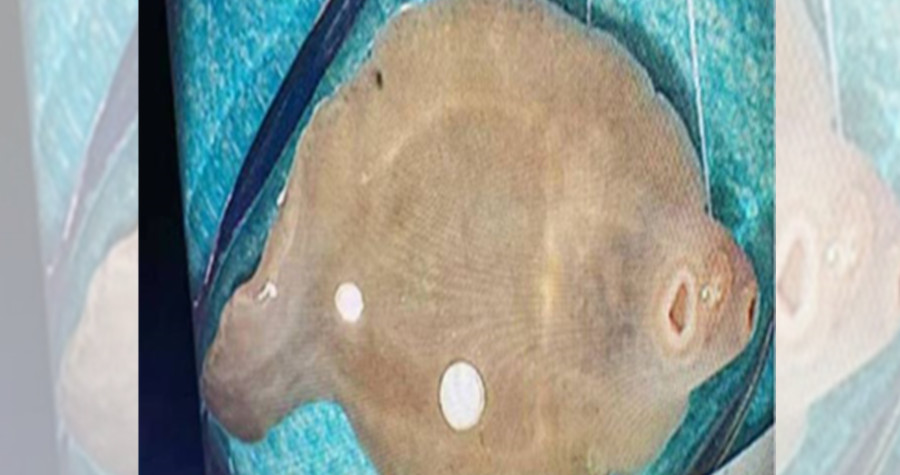 女子的肝臟被「肝巨片形吸蟲」吃掉三分之一。（翻攝《廣西新聞網》）