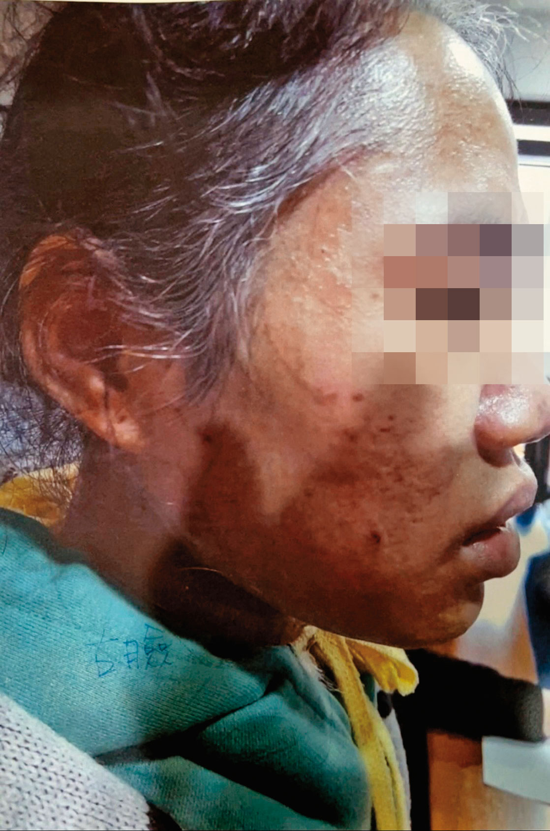30歲的阿迪逃出警官住處時,髮鬢灰白,樣貌憔悴。(讀者提供)