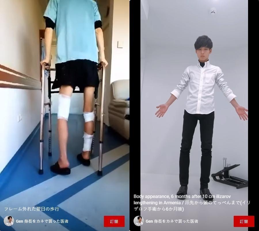 經過5個月、耗資120萬元,男醫師撐過手術的痛苦,成功長高10公分,成果令他相當滿意。(翻攝「Gen 身長をカネで買った医者」YouTube)