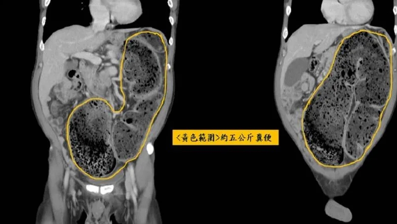 新竹縣一名58歲的男子便祕20天，直到腹脹到受不了才就醫。（翻攝自中國醫藥大學新竹附設醫院臉書）