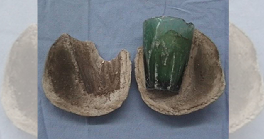 女子把7公分的玻璃杯塞入下體，卻拿不出來成為結石。（翻攝sciencedirect.com）