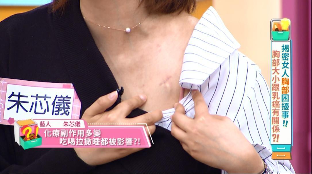 朱芯儀秀出身上因為治療的傷口。（東森提供）