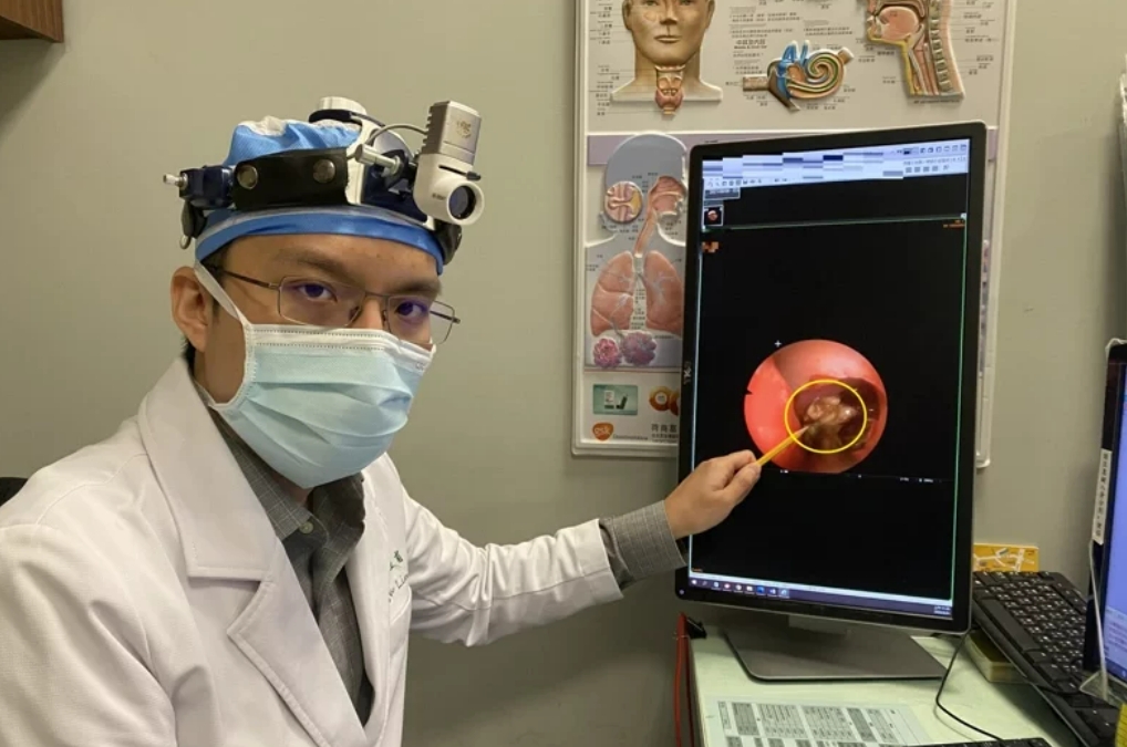 男子罹患黴菌性鼻竇炎，接受鼻部內視鏡手術，取出直徑1公分的黴菌球。  