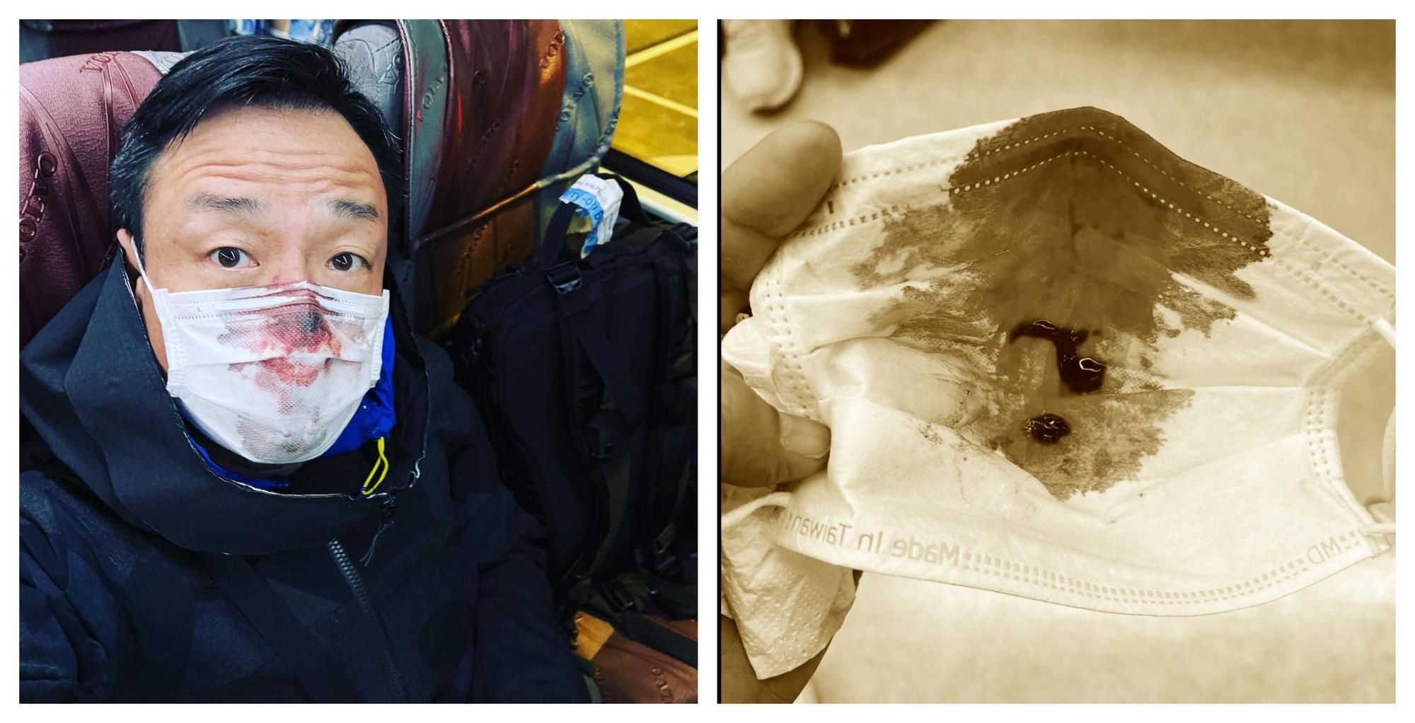 王喜入境台灣時篩檢PCR被捅傷，畫面驚悚。（翻攝王喜臉書，照片經變色處理）