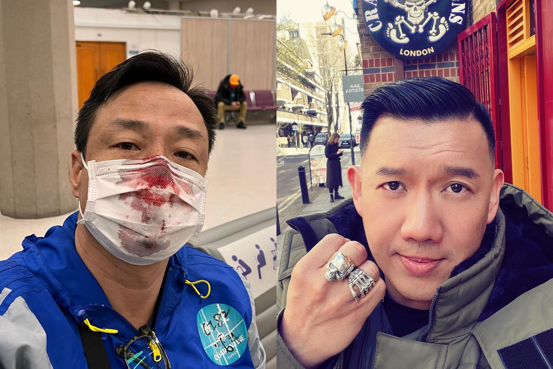 王喜因在台灣機場採檢時鼻子不慎被戳流血怒控醫護是「凶手」，同是港星的杜汶澤則表示「我們在尋求自由的時候，亦應該尊重別人的習慣和文化」。（翻攝自王喜、杜汶澤臉書）