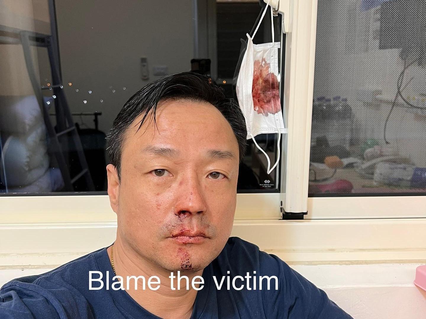 港星王喜之前在機場採檢時,不慎遭醫護戳到鼻孔流血,讓他數度怒發文在臉書找「凶手」。(翻攝自WONG HE 王喜臉書)
