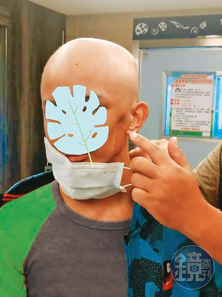 許姓少年動過2次削臉手術，左臉明顯出現凹陷。（讀者提供，少年已變裝處理）