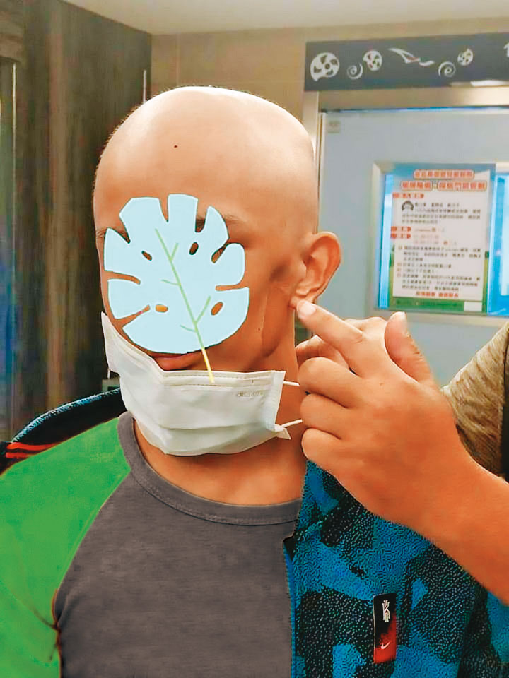 許姓少年動過2次削臉手術，左臉明顯出現凹陷。（讀者提供，少年已變裝處理）