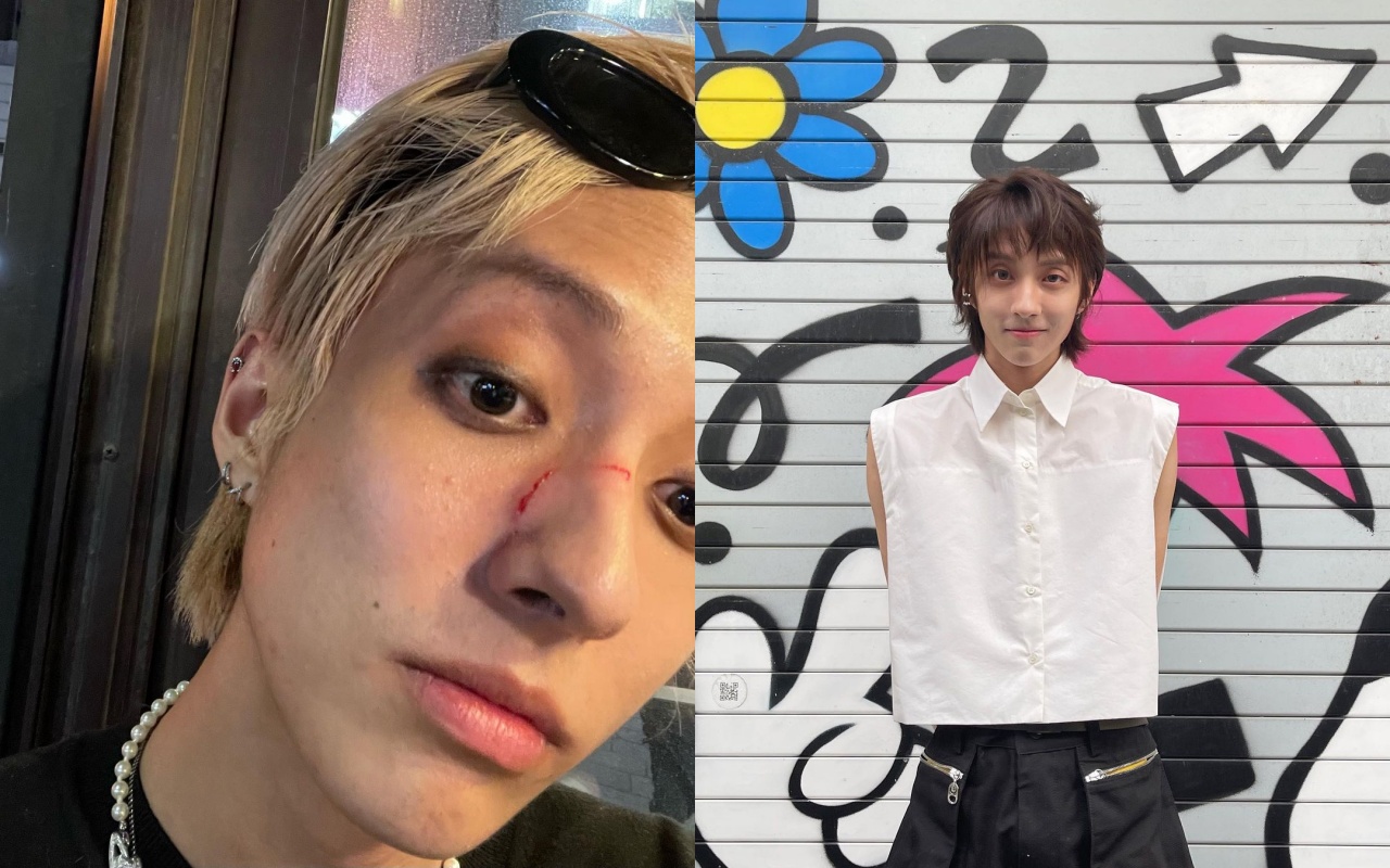 韓國出櫃歌手Holland被陌生人打傷臉，還罵他是「骯髒的狗東西」。（翻攝Holland IG)