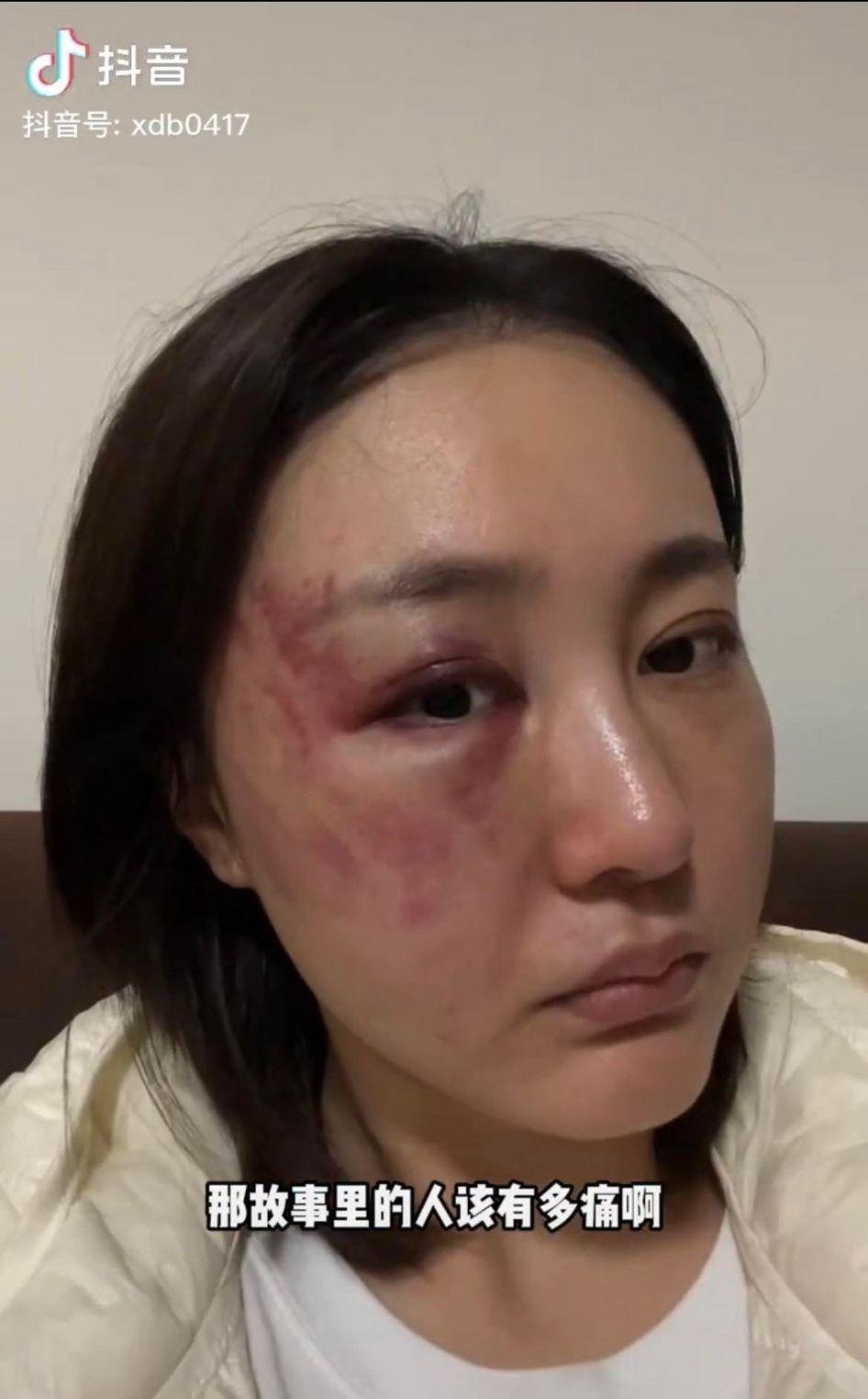徐大寶透露丈夫還曾打算拿枕頭悶死自己，表示不知道自己能不能活到拿離婚證書那天。（翻攝徐大寶抖音）
